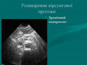 Узи панкреатит